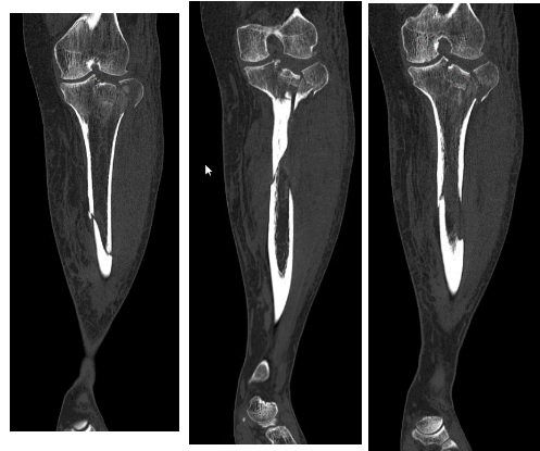 Fractura platoului tibial: de la operație la recuperare