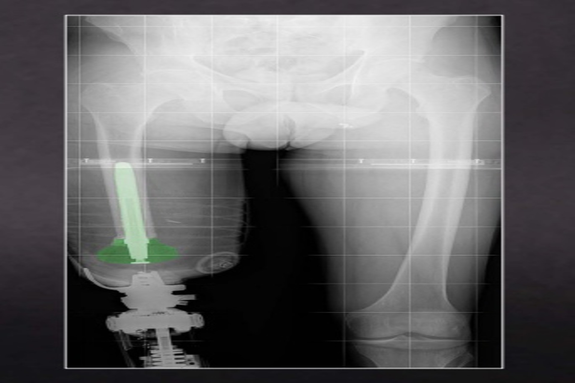 The Keep Walking Implant — A Solution for Lower-Limb Amputees with an Intact Femur or at Least 14 cm of Femur Preserved