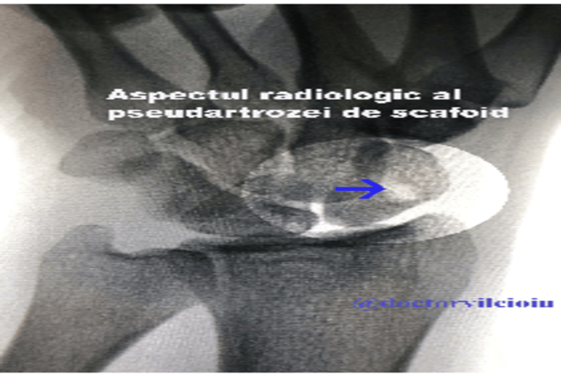 Tratamentul chirurgical artroscopic cu autogrefă osoasă și șurub de compresie
