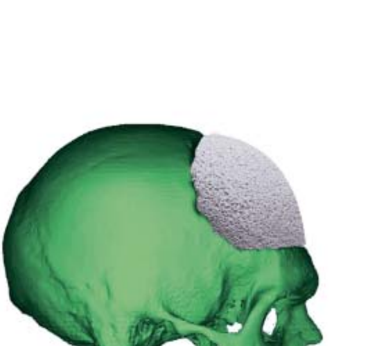 CustomBone Service™ — model 3D al craniului pacientului cu implantul personalizat poziționat pe defect (material Finceramica)