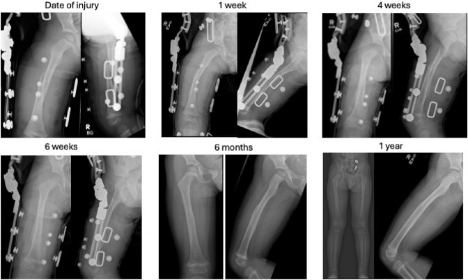Evoluția consolidării fracturii de femur sub tratament cu DF2 (radiografii: la prezentare, 1, 4 și 6 săptămâni, 6 luni și 1 an)