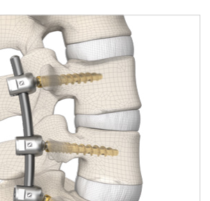 DIPLOMAT® — construct șurub–tijă fixat pe segmentele vertebrale lombare (render anatomic SIGNUS)