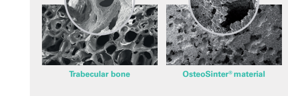 OsteoSinter® — comparație microscopică între osul trabecular și materialul poros OsteoSinter®, cu porozitate bio-mimetică (material AMES Medical)