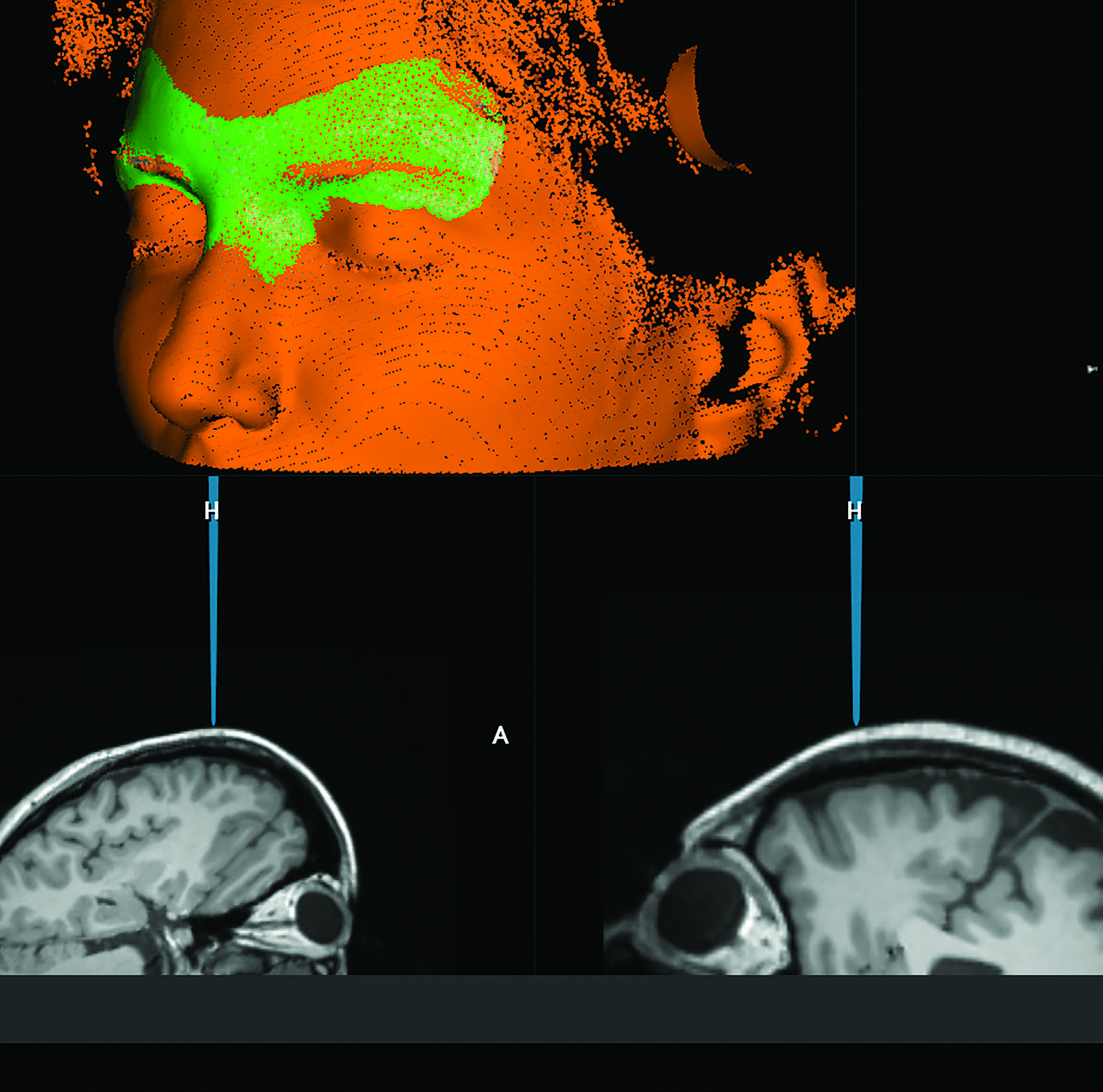 A constellation of over 300,000 virtual reference points optically digitized on the cranial surface, for contactless registration (7D Surgical/Orthofix material)