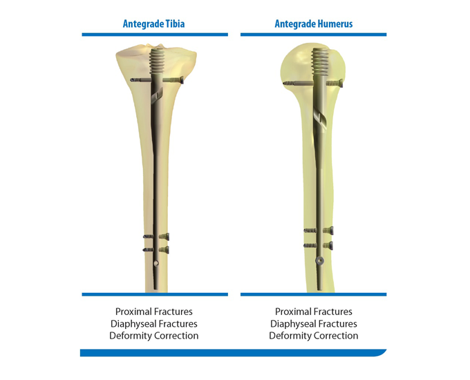 Aplicații GAP Nail: abord antegrad la tibie și humerus (fracturi proximale, diafizare, corecție de diformitate)