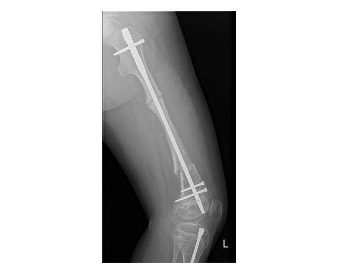 Radiografie: constructul GAP Nail (tijă + placă) la nivelul femurului