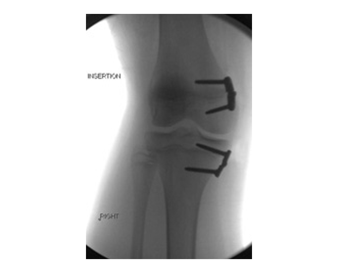 Radiografie: corecție de diformitate la genunchi cu Hinge Plate