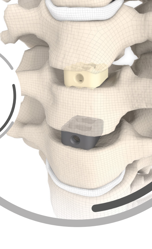 RABEA® — cage implanted in the cervical spine using the Smith–Robinson technique (anatomical SIGNUS render)