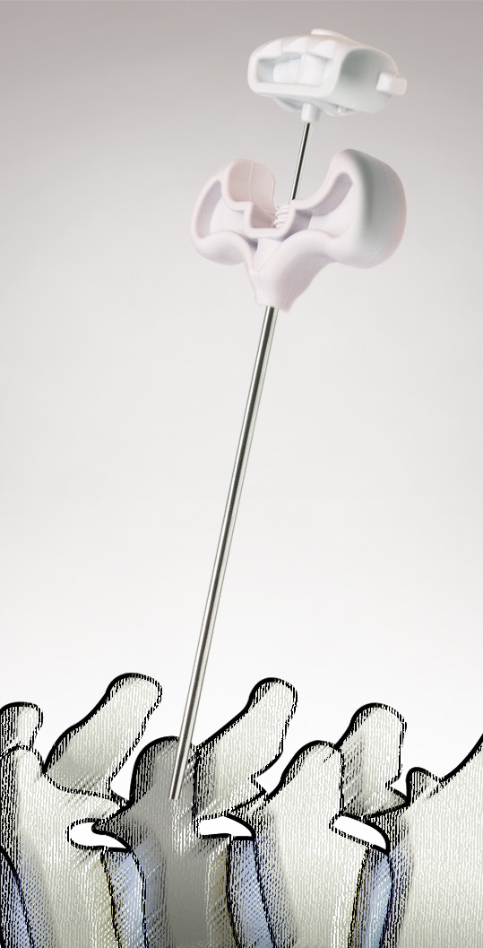 SPASY™ — acul de acces osos introdus transpedicular în corpul vertebral (material Seawon Meditech)